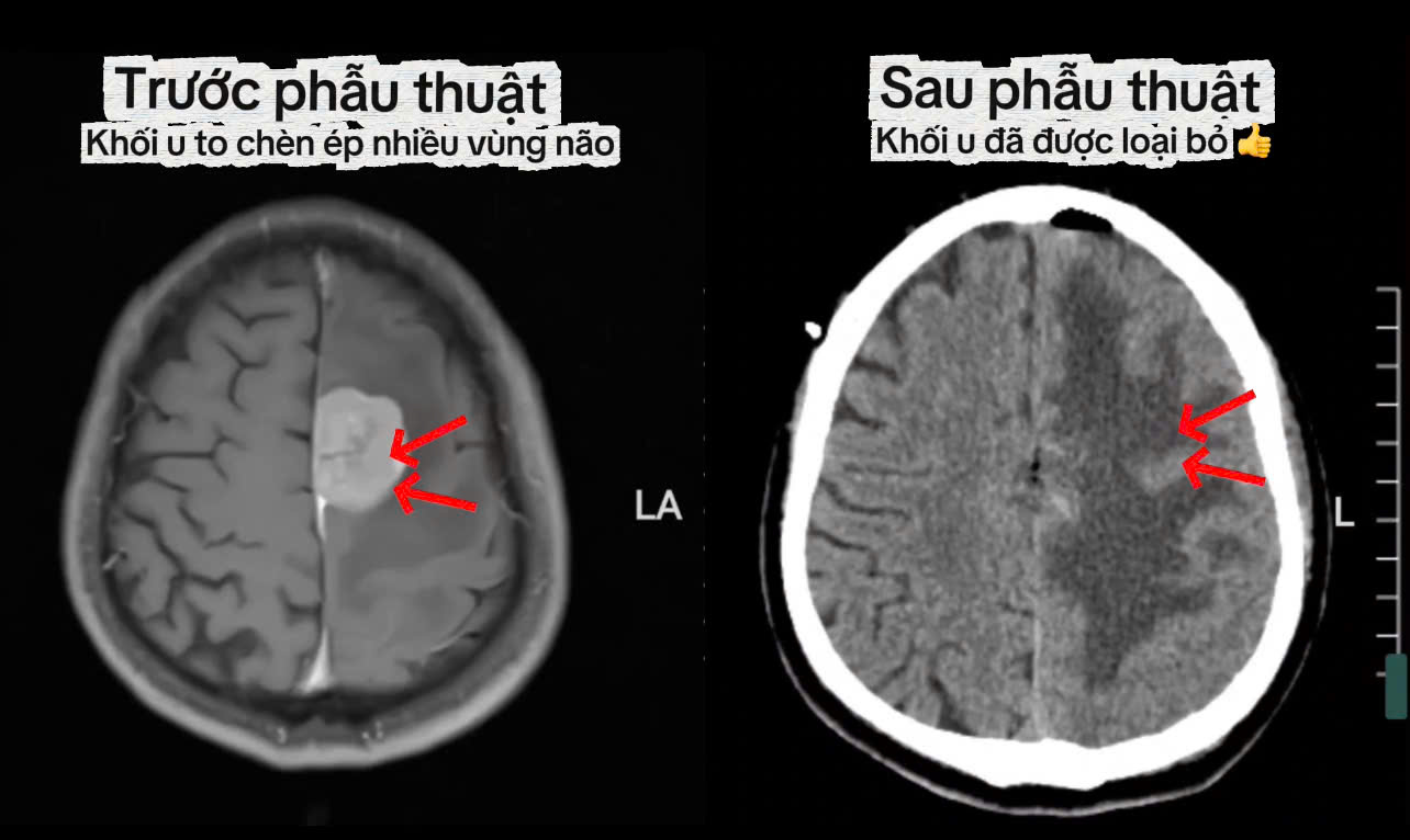 PHẪU THUẬT LOẠI BỎ U MÀNG NÃO LIỀM NÃO BẰNG KỸ THUẬT VI PHẪU HIỆN ĐẠI