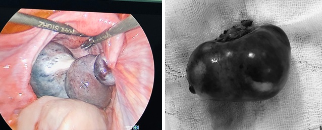 Phẫu thuật thành công cắt u quái buồng trứng xoắn ở trẻ 10 tuổi